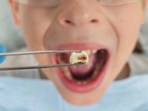 Best Emergency Wisdom Teeth Removal in Fairfield Beach, OH